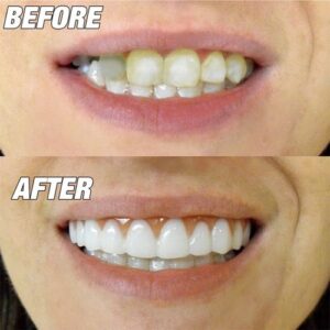 5-Piece Beauty Tool Set: False Teeth and Fake Tooth Covers
